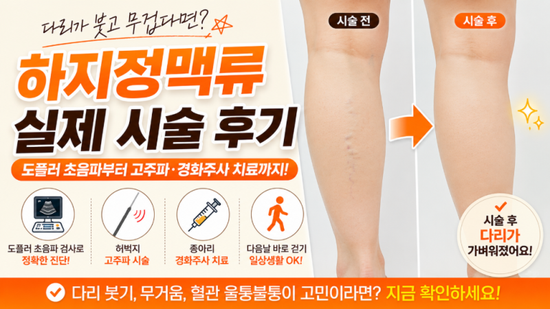 종아리 하지정맥류 실제 시술 후기｜다리가 붓고 무겁다면 꼭 확인하세요 (도플러 초음파부....