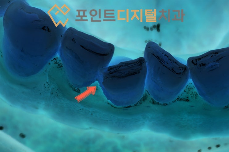 아차 하는 순간 툭! 젓가락 씹어 깨진 앞니, 당일 레진 빌드업으로 감쪽같이 복구하기 / 천안 아산