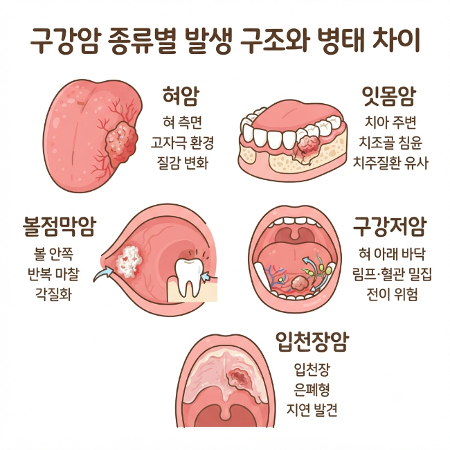 구강암 종류 총정리｜혀암·잇몸암·볼점막암의 발생 구조와 병태생리 차이