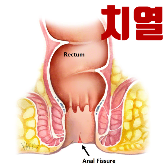 치열 뜻 증상, 항문 찢어짐 선홍색 피, 응급 대처, 수술 방법, 치루 비교