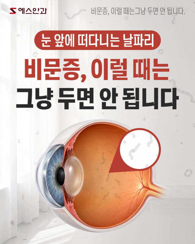 안산 안과 | 비문증, 그냥 넘기면 안 되는 증상은?