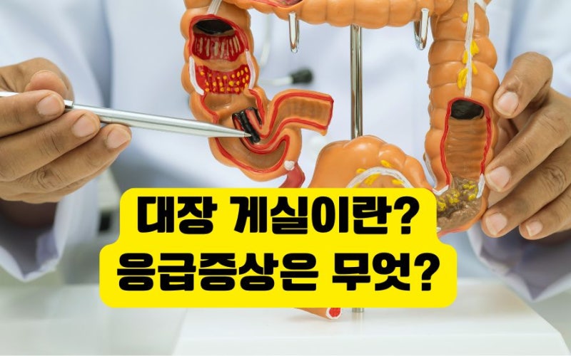 대장 게실이란? 게실염 응급증상 게실증 게실염 차이 치료 관리 음식은?