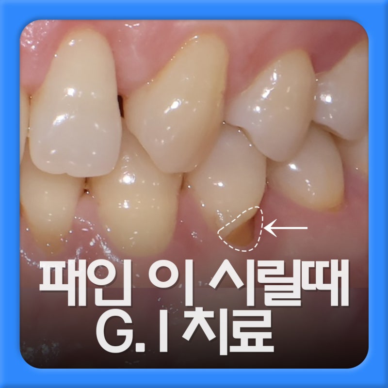 찬물 마실 때마다 이가 시리면 치경부마모증? GI 특징