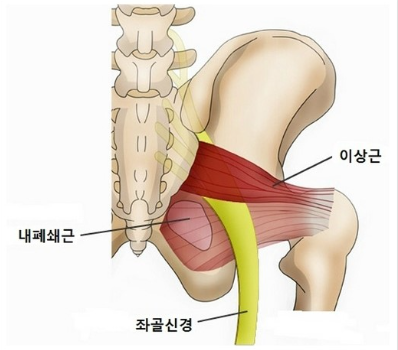 이상근 증후군 자가진단법 발병원인 스트레칭 방법