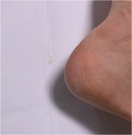 일본발각질제거팩 미루다 발 이 지경 될 뻔했다