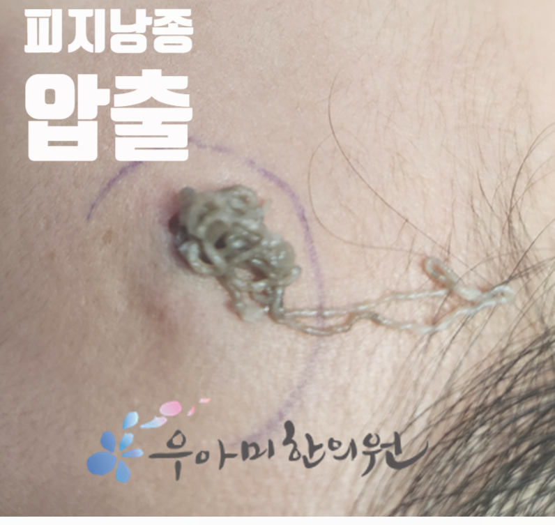 이마 피지낭종, 제거 비용이 병원마다 다른 이유