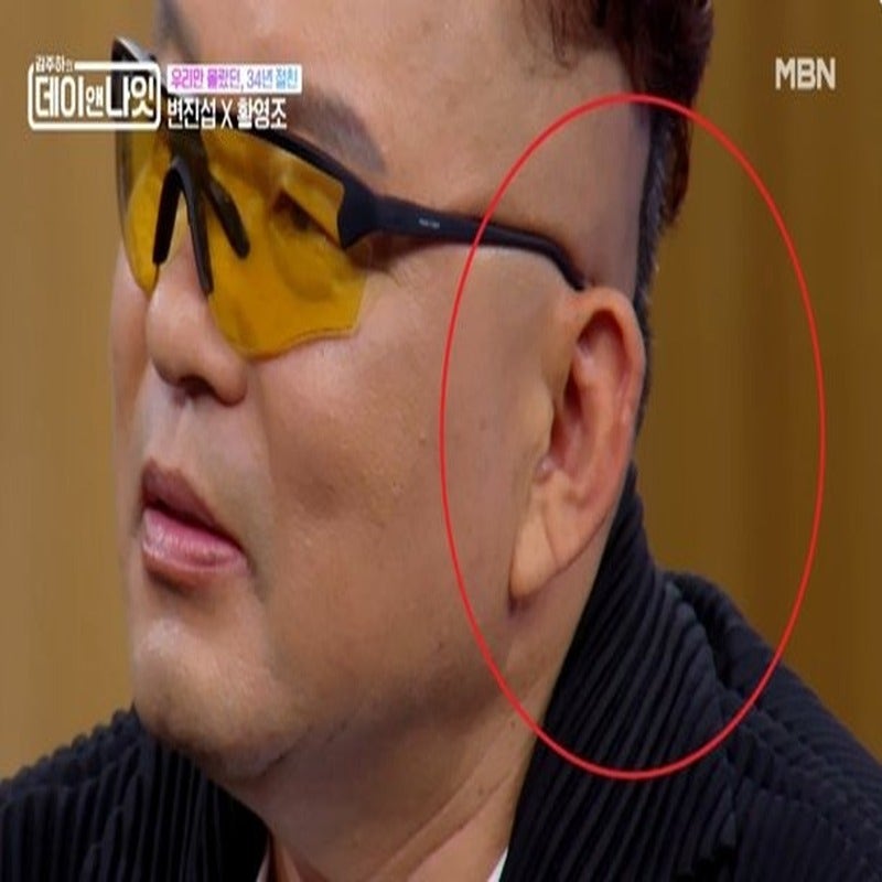 변진섭 골프공 사고, 황영조 뇌진탕 50바늘 꿰맨 사연