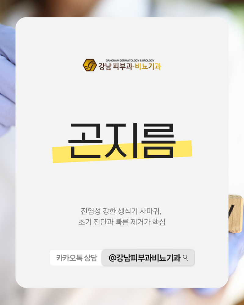 곤지름 증상 방치하면 크기가 커질까? 재발 줄이는 초기 치료의 중요성