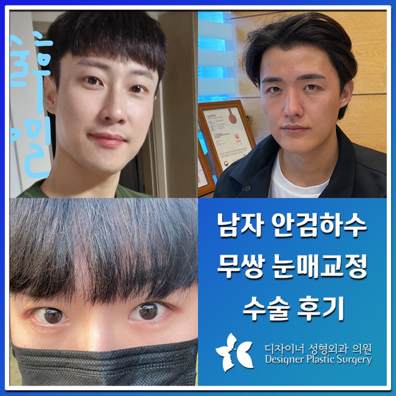 안검하수 증상이 있다면? 남자 무쌍 눈매교정술이 필요한 경우와 선택 기준
