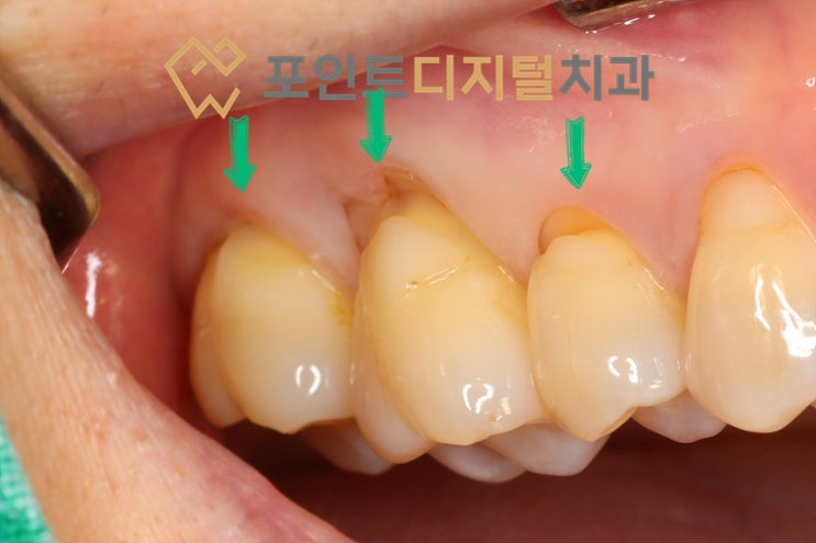 [탕정치과] 이가 시려서 보니 기존 재료가 떨어졌다면? 치경부 마모증·충치 정밀 레진 치료 과정 / 천안 아산