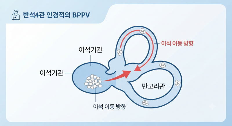 이석증 40만명 시대,꼭 확인해야 할 3가지