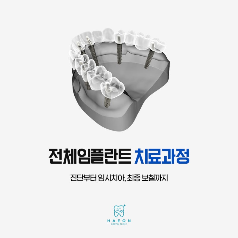 호매실치과 전체임플란트 치료 과정, 임시치아와 식사는 어떻게 달라질까요