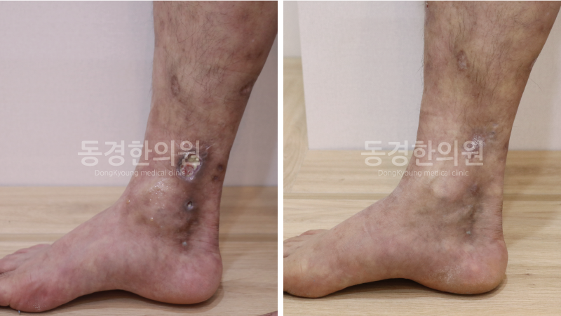 노인성자반증 치료 초기 증상 하나부터 열까지 정리해드립니다.