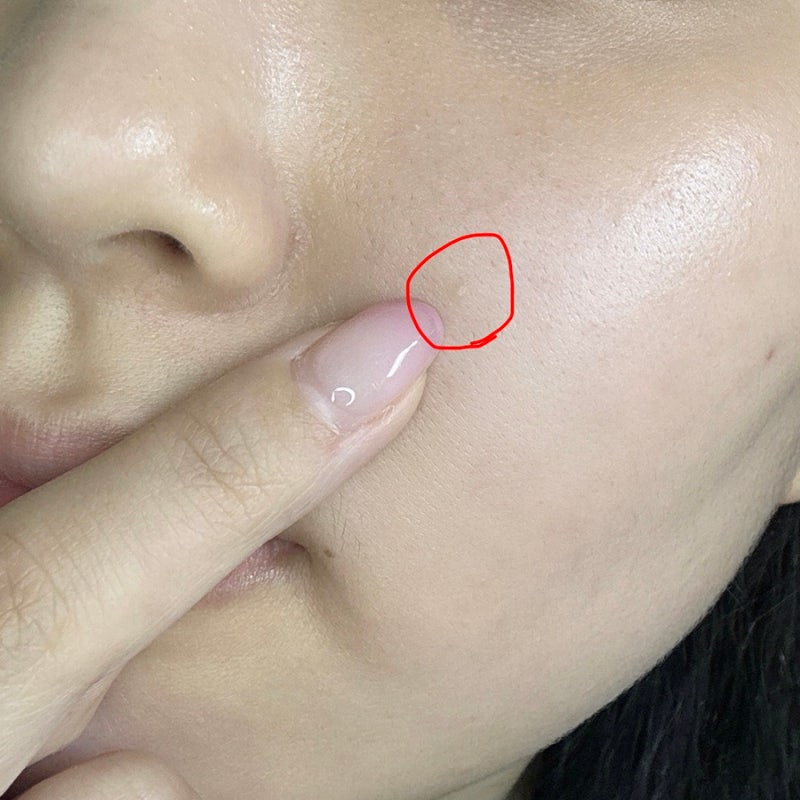 눈가 비립종 제거 피부과 후기, 통증 및 후관리 방법 정리