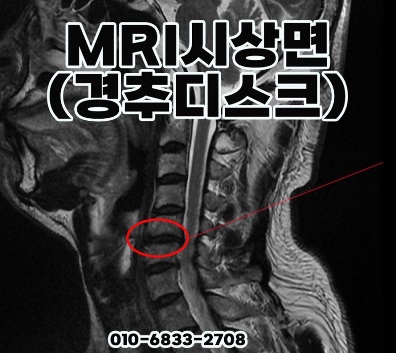 후방추돌 교통사고 같은 목디스크 진단인데 합의금이 다른 이유