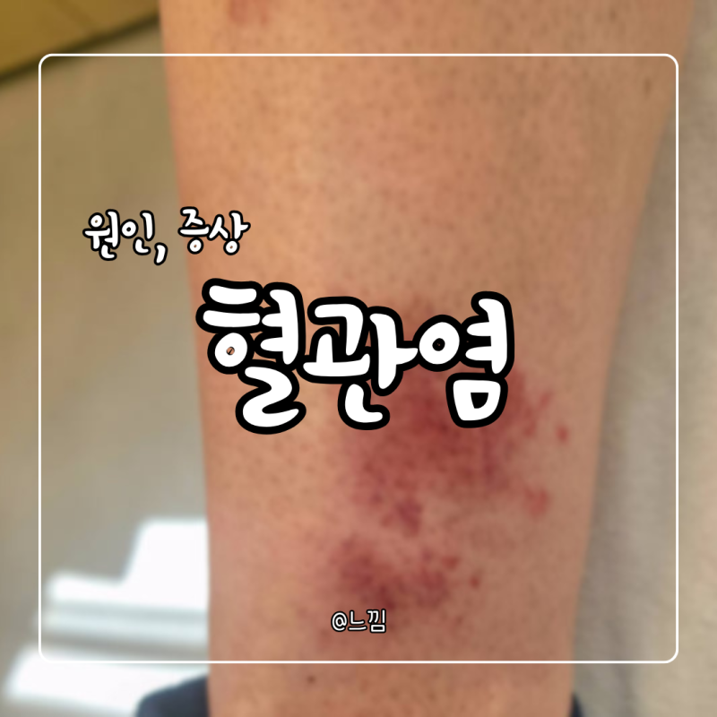 혈관염 증상 원인 치료 피부 혈관염