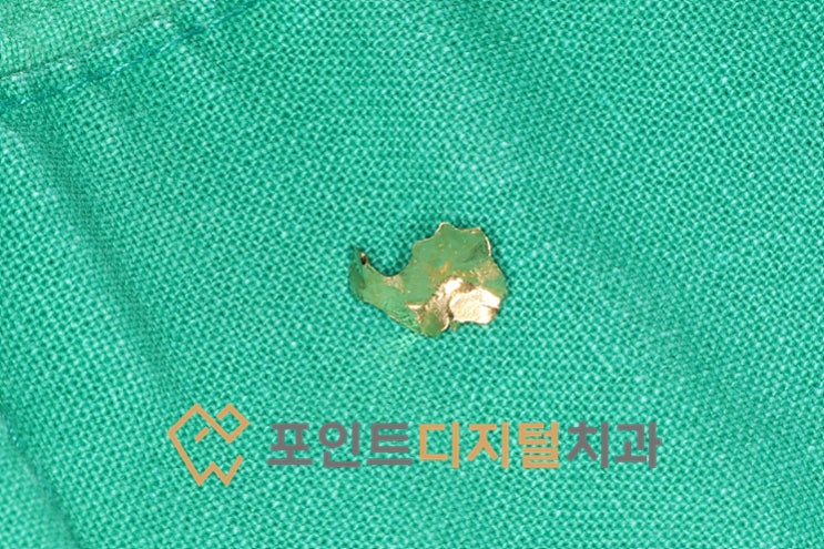[탕정 치과] 골드 인레이 탈락, 꼭 다시 본을 떠야 할까요? 치아를 지키는 원데이 레진 빌드업 치료 / 천안 아산