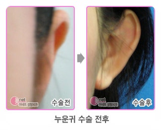 누운귀 누운귀 수술 방법과 누운귀성형후기에 대해서