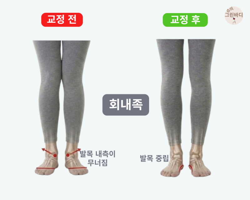 회내족(과회내), 발목이 안쪽으로 무너진다면? 원인부터 교정운동까지 총정리