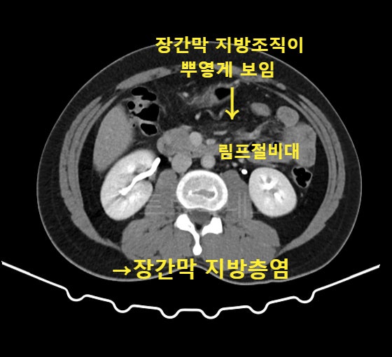 대구 복부CT, 복부초음파 정상인데도 복통이 지속된다면?