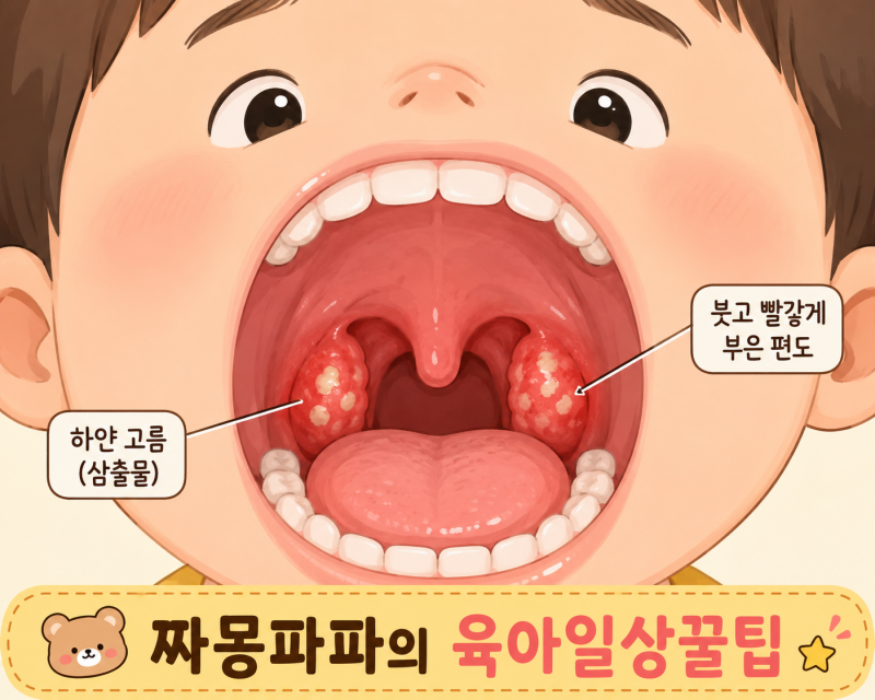 아이 편도염, 열은 왜 안 떨어질까? 해열제 교차복용법 + 바이러스성·세균성 구분법