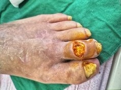 부산 고압산소치료｜당뇨발 상처, 왜 오래 낫지 않을까요? 실제 치료 사례