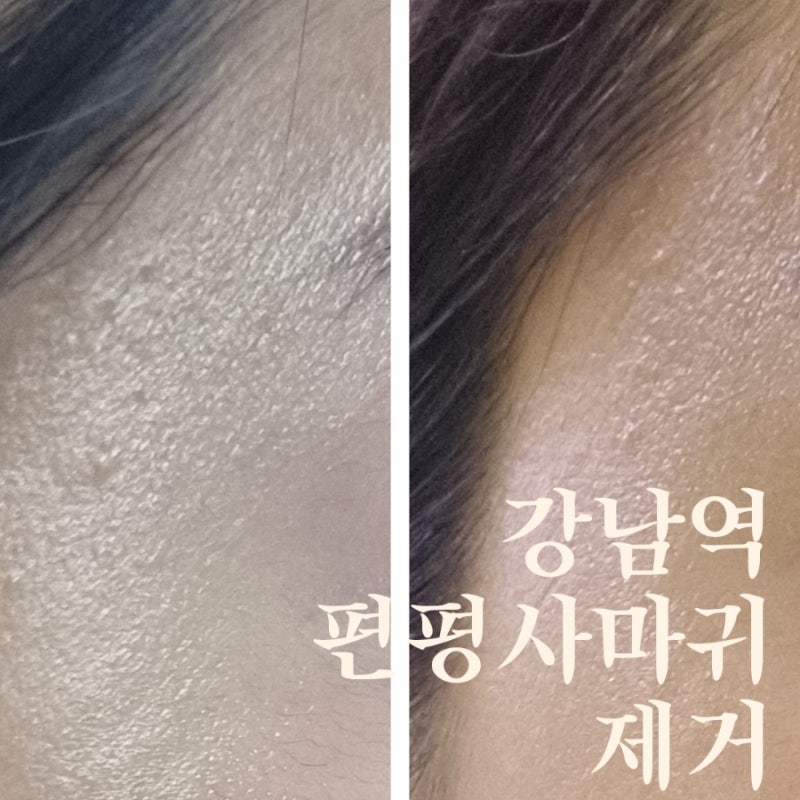 강남역 한의원 편평사마귀 제거 성지 방문 후기
