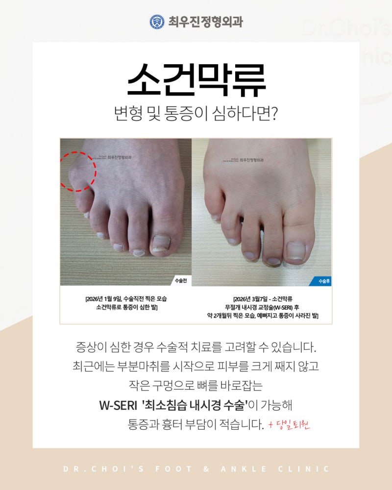 새끼발가락굳은살 통증 및 변형까지 한번에 해결하려면