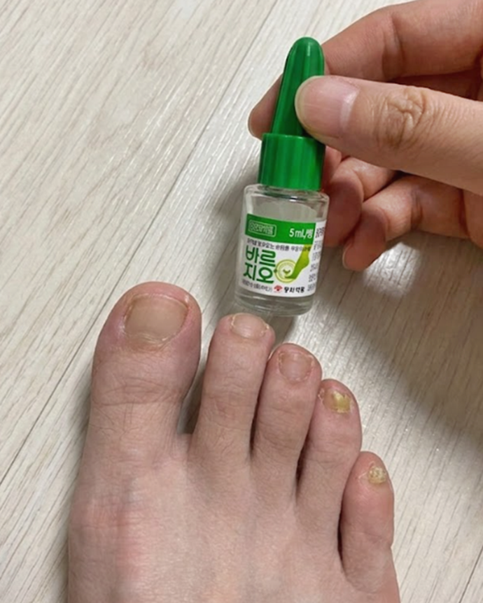 발톱무좀 바르지오 네일라카 연고 사용 시 필요한 관리사항