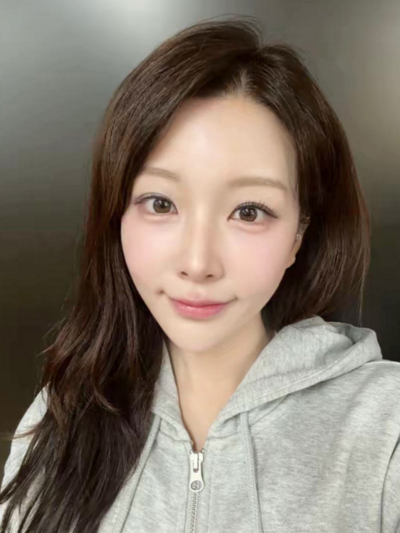 서울아몬드성형외과논현점 절개 쌍꺼풀수술 눈위꺼짐 눈두덩이지방이식 가격 붓기 후기 5일....