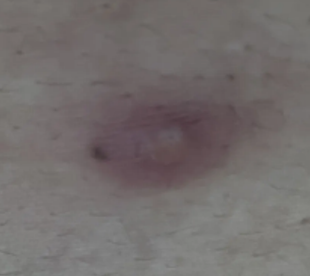 여자 사타구니 종기, 자주 생기는 원인이 뭘까? 제거 관리 방법까지