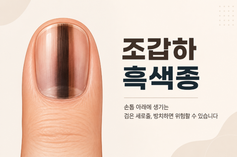 손톱발톱에 검은 줄, 단순 멍일까 흑색종일까?