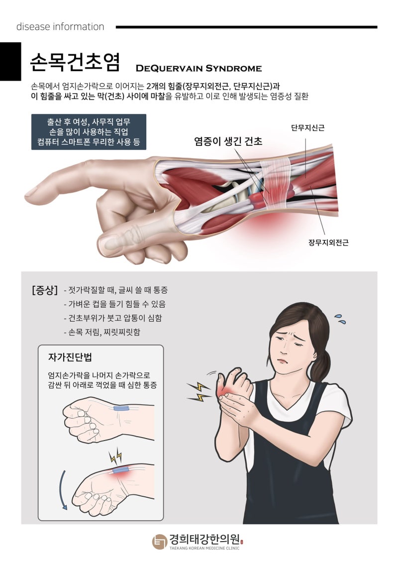 병뚜껑 돌릴 때 심해지는 엄지 쪽 손목 통증: 드퀘르뱅 병(De Quervain)과 초음파 검사