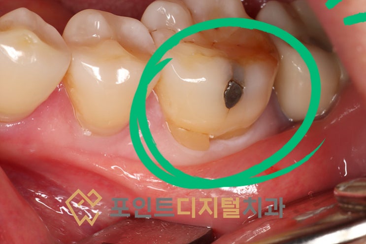 [탕정역 치과] 
