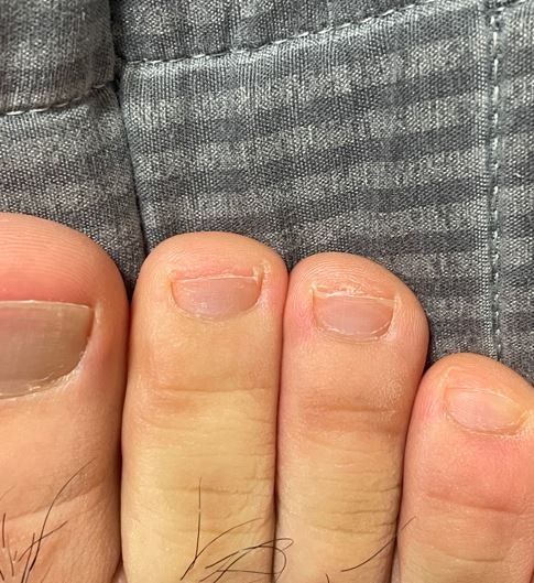 발톱무좀약 추천 빠르게 치료하는 방법, 완치 후기