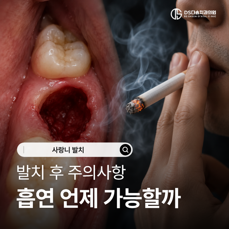 연산동사랑니 발치 후 담배 언제부터 피워도 될까요