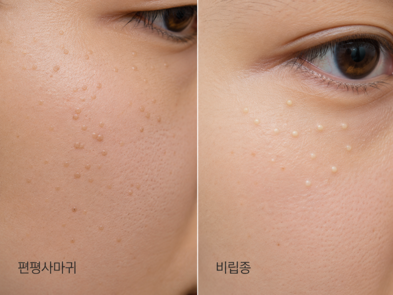 천안편평사마귀? 비립종? 레이저치료해도 재발한다? 불당피부과, 비슷해 보여도 치료가 다른....