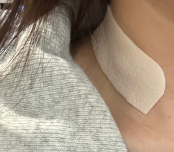 갑상선암 수술 후 6개월간의 흉터 치료 변화 기록 (강남세브란스에서 개인 병원으로)