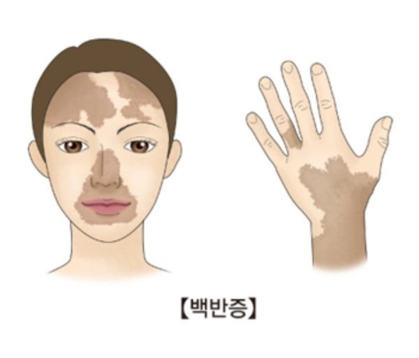 백반증, 항산화와 관련이 있을까?