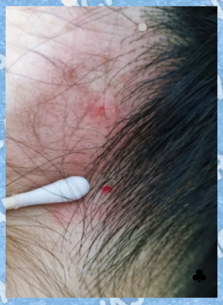지루성 두피염 약국 니조랄 샴푸로도 효과 없었던 이유