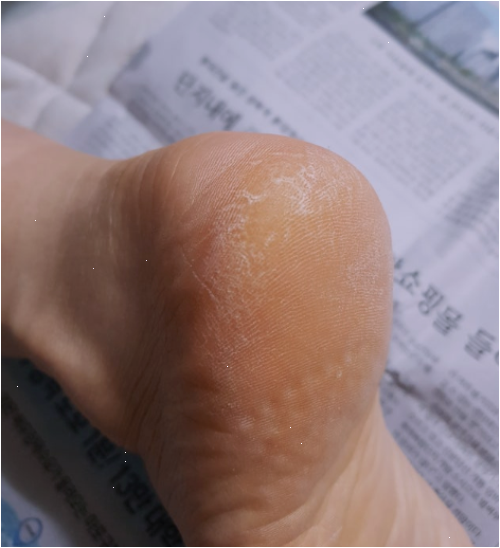 돈키호테발톱무좀 크림이랑 각질기 둘 다 써본 차이