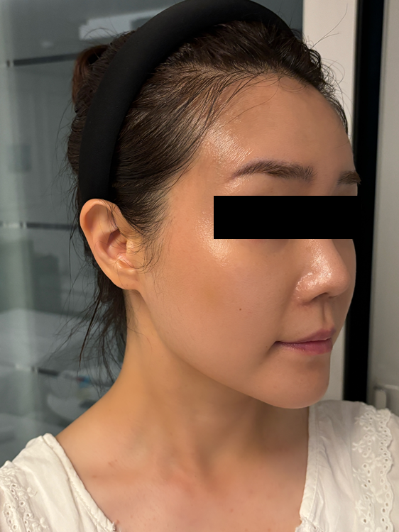 사각턱보톡스 침샘보톡스 전후 비교 후기 (리터치 후 변화)