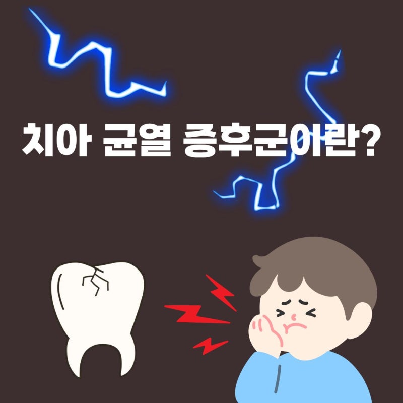 [마곡나루치과] 딱딱한 것 씹을 때 깜짝 놀라는 통증, '치아균열증후군'에 대해서