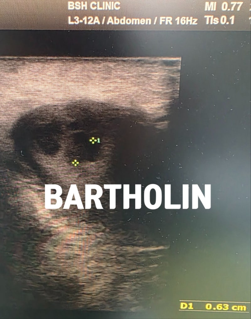 바르톨린낭종, 단순한 혹인가? 바르톨린농양(Bartholin's abscess)의 진단부터 Marsupialization, 항생....