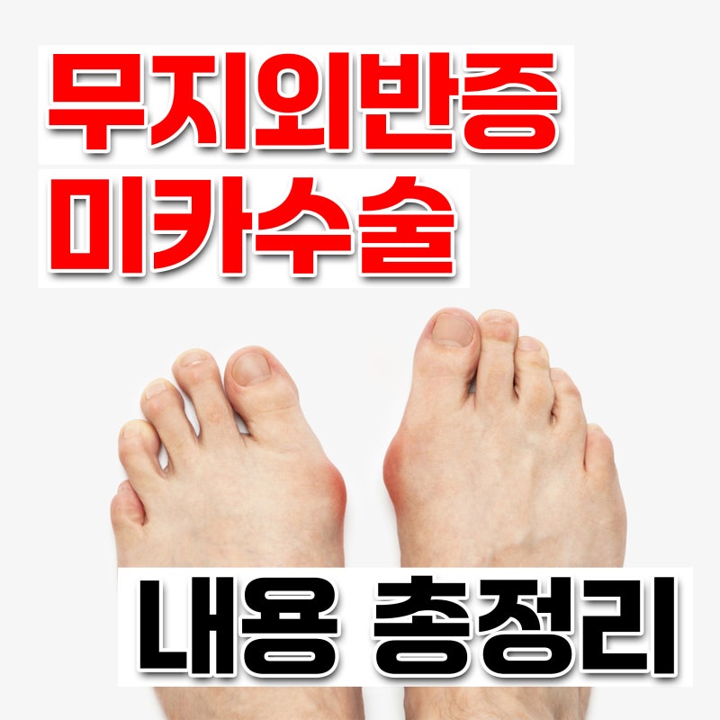 최소침습 무지외반증 미카(MICA)수술 비용 실비보험 청구 총정리