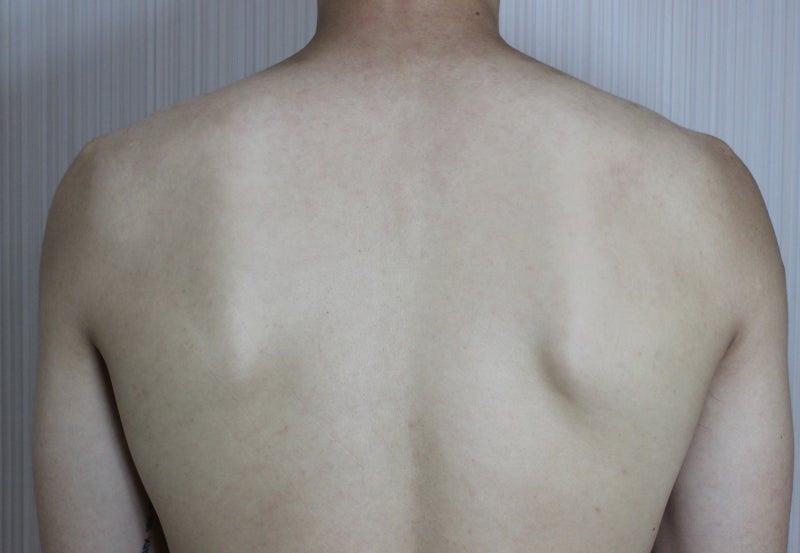 등드름치료 과정 홈케어하다 직접 경험한 피부과 후기