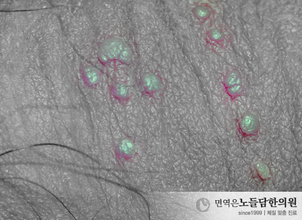 남자 곤지름 잠복기·증상·자연치유 가능 기간은?