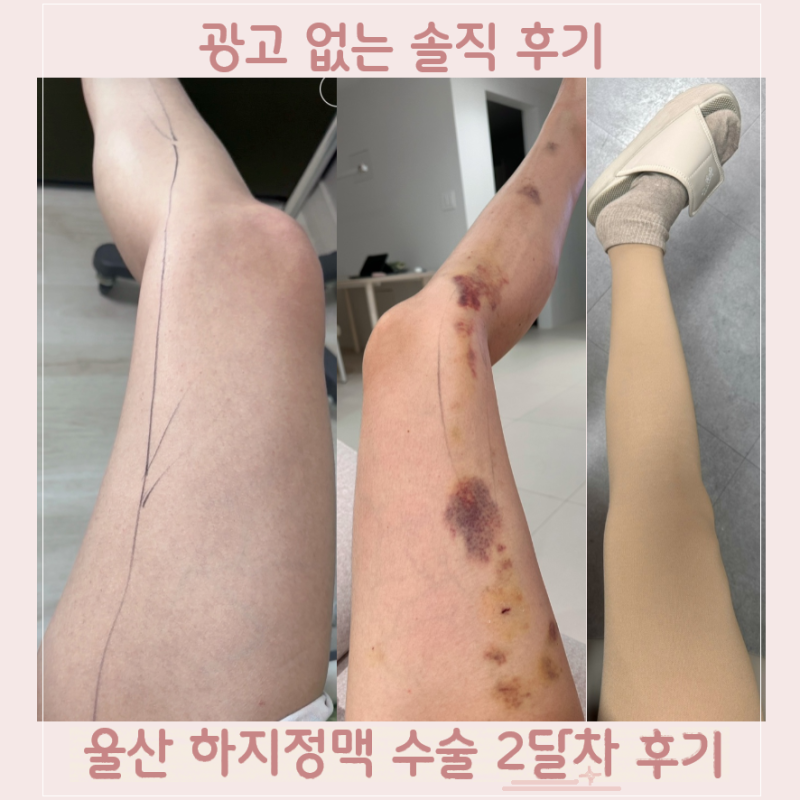 울산 하지정맥 병원 | 수술 2달차 후기 및 부작용