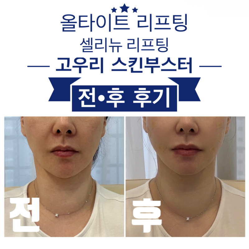 서울 강남역 피부과 추천 관리 올타이트, 셀리뉴 리프팅, 고우리 스킨부스터 가격 및 후기