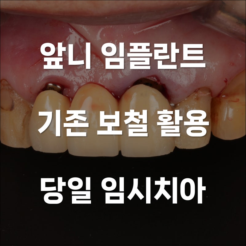 앞니 임플란트 당일 임시치아, 기존 보철 그대로 활용
